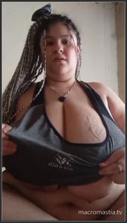 teen macromastia