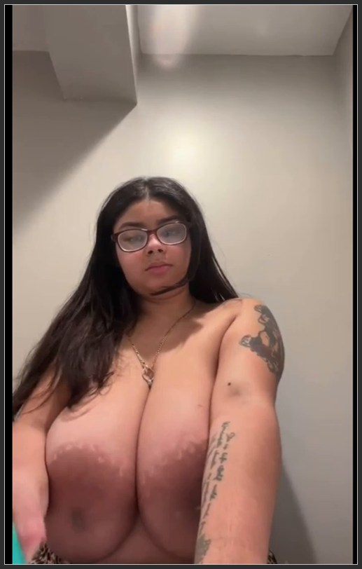 Macromastia Breasts